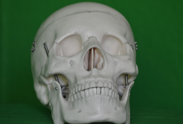 Cell: Ученые научились определять болезнь Альцгеймера и инсульт по черепу