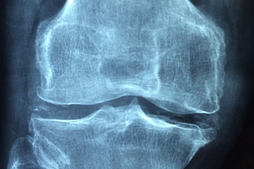 Учёные США нашли бактерии, при ревматоидном артрите атакующие хрящевую ткань