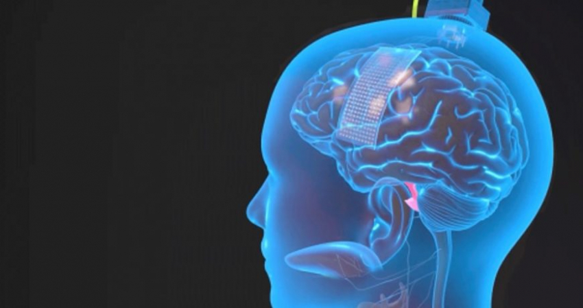 Люди с параличом вернули себе способность говорить за счет имплантов с искусственным интеллектом