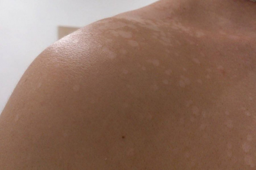 «Синяки, пятна, утомляемость»: Травматолог рассказал, как обнаружить дефицит витаминов без анализов